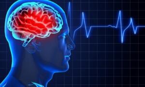 Профилактика инсульта