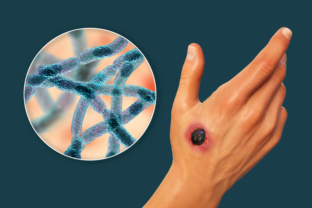 WATCH OUT FOR ANTHRAX! PREVENTION AND PROTECTION MEASURES