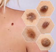 Қал (мең), олардың қаупі