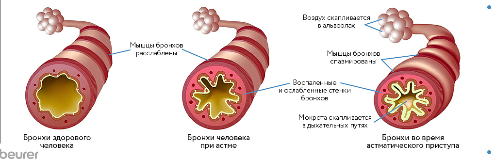 бронхиальная астма.png