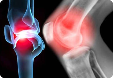 2016.11.02 Остеоартрозоартрит. Защита суставов 7.jpg