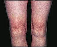 2016.11.02 Остеоартрозоартрит. Защита суставов 4.png