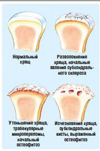 2016.11.02 Остеоартрозоартрит. Защита суставов 3